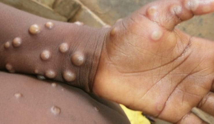 First Case Of Monkeypox Confirmed In Johannesburg, South Africa